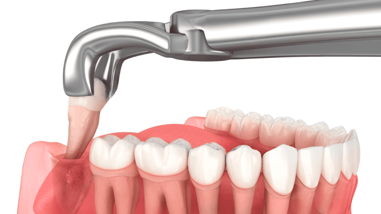 Удаление зуба мудрости