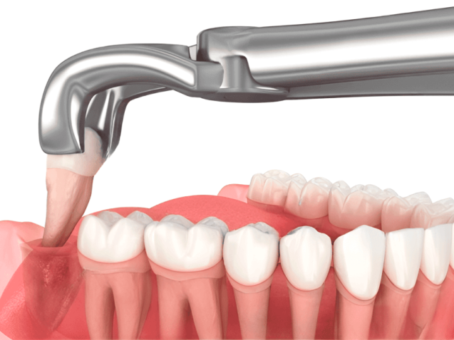 Удаление зуба мудрости