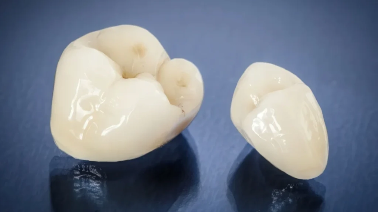 Когда нужно менять старые коронки