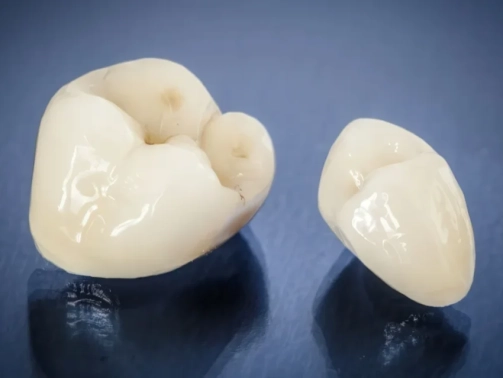 Когда нужно менять старые коронки