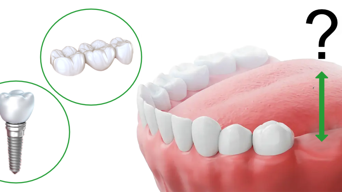 most-ili-implant