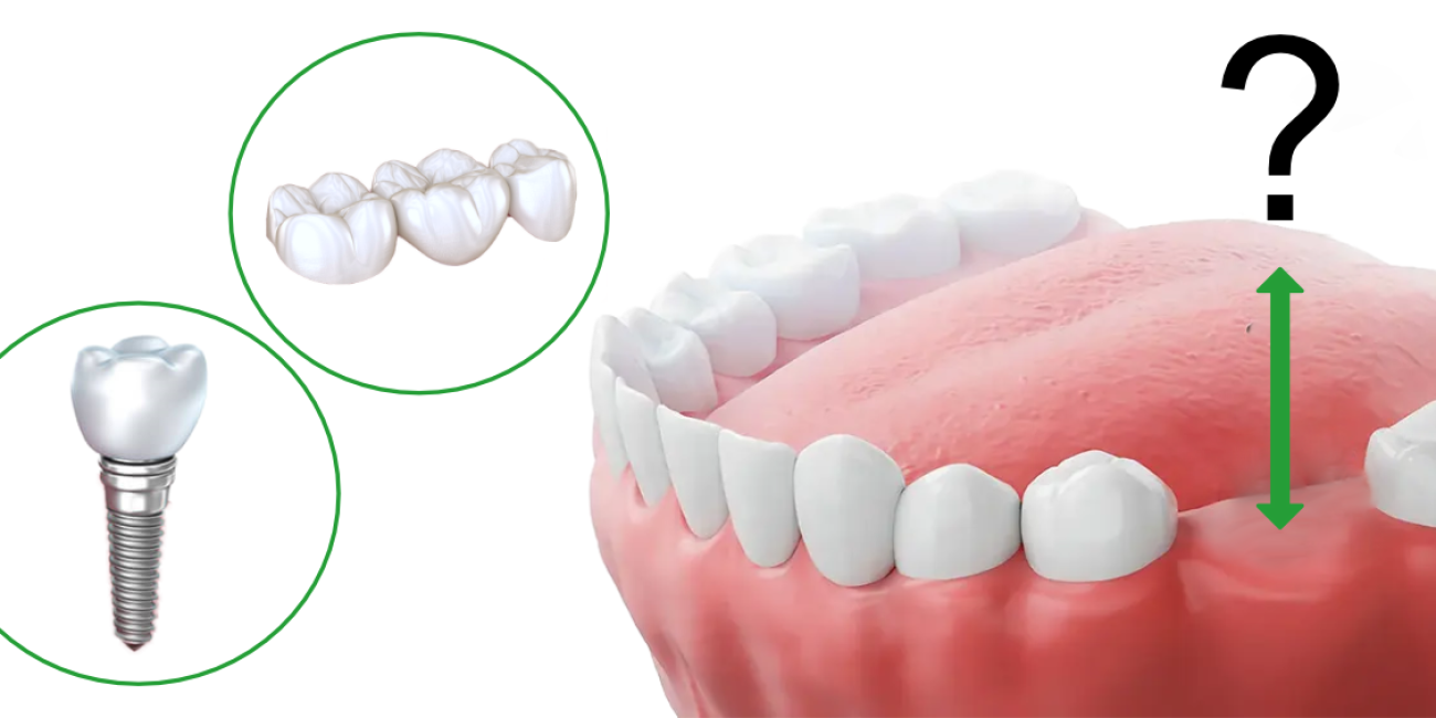 most-ili-implant