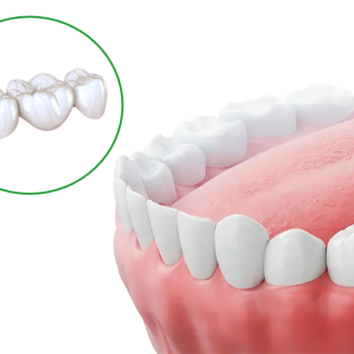 most-ili-implant