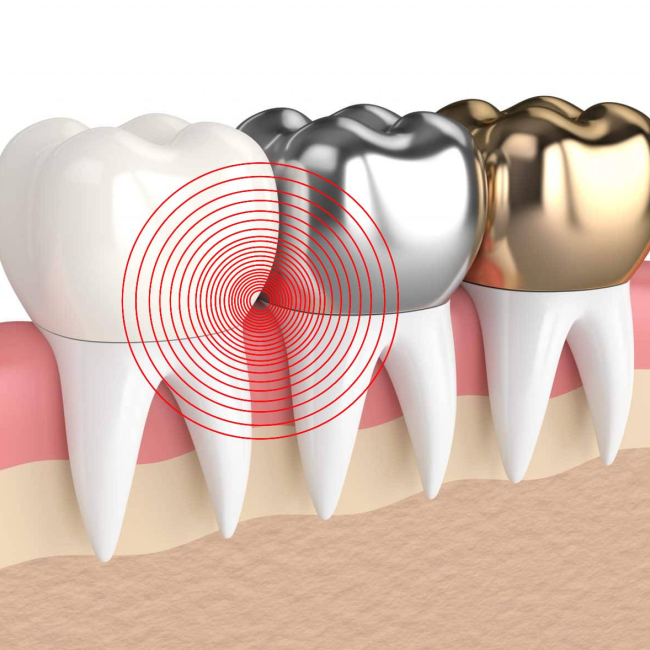 tooth-hurts-under-crown